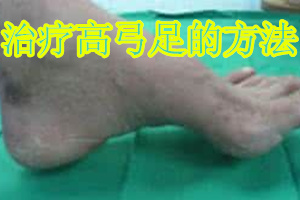 治疗高弓足的秘方,高弓足的保守锻炼治疗方法是什么
