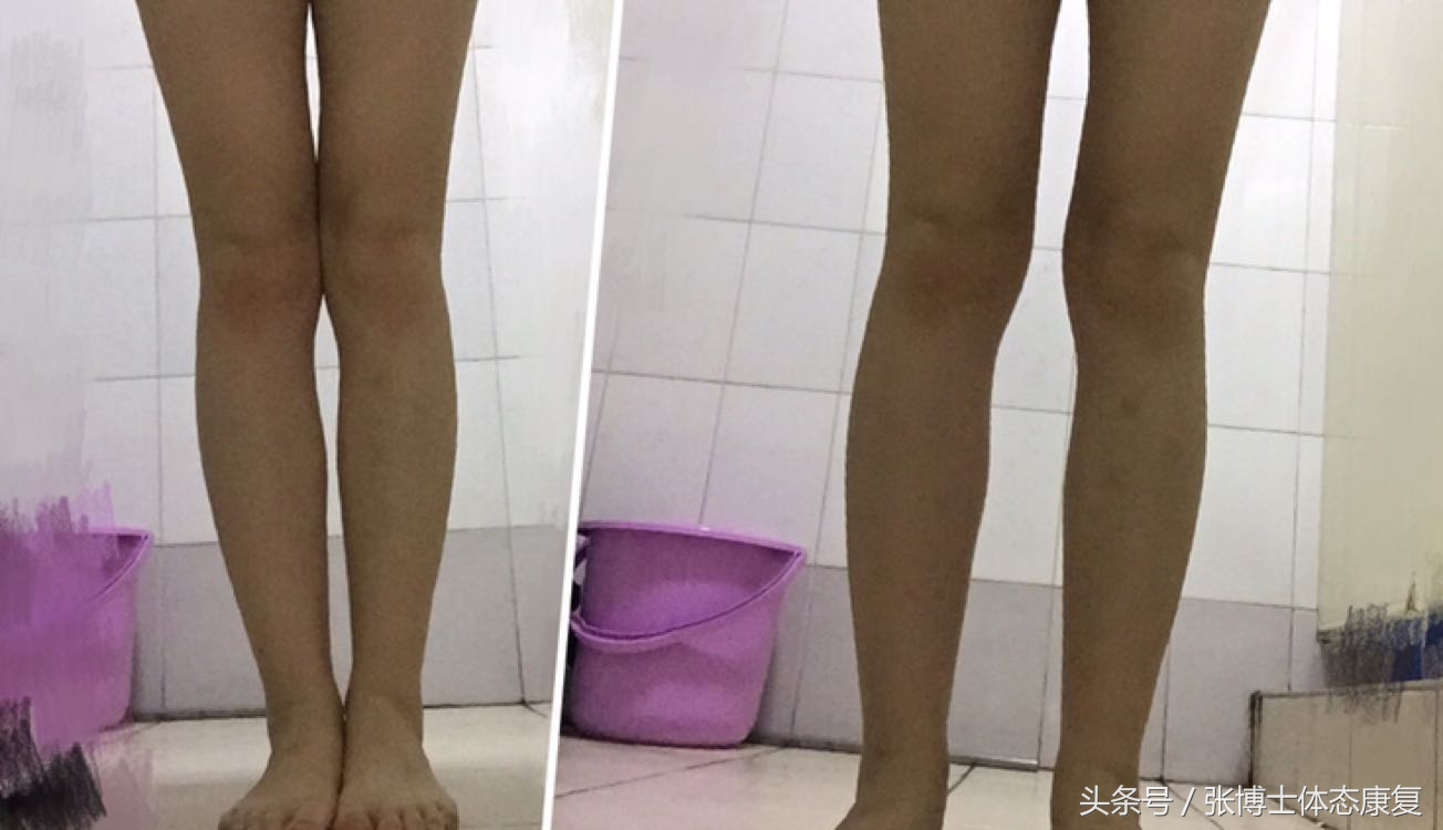 体态纠正膝内扣,膝关节外翻是o型腿吗