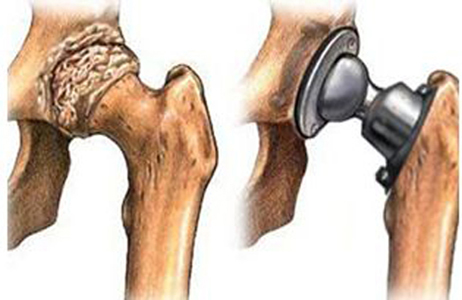 股骨头坏死介入治疗多长时间有效,治疗股骨头坏死费用要多少钱