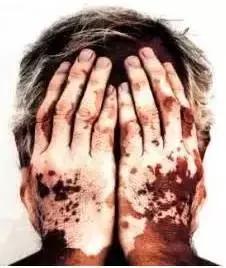 白癜风治疗要小心走入误区,白癜风自我诊断小妙招