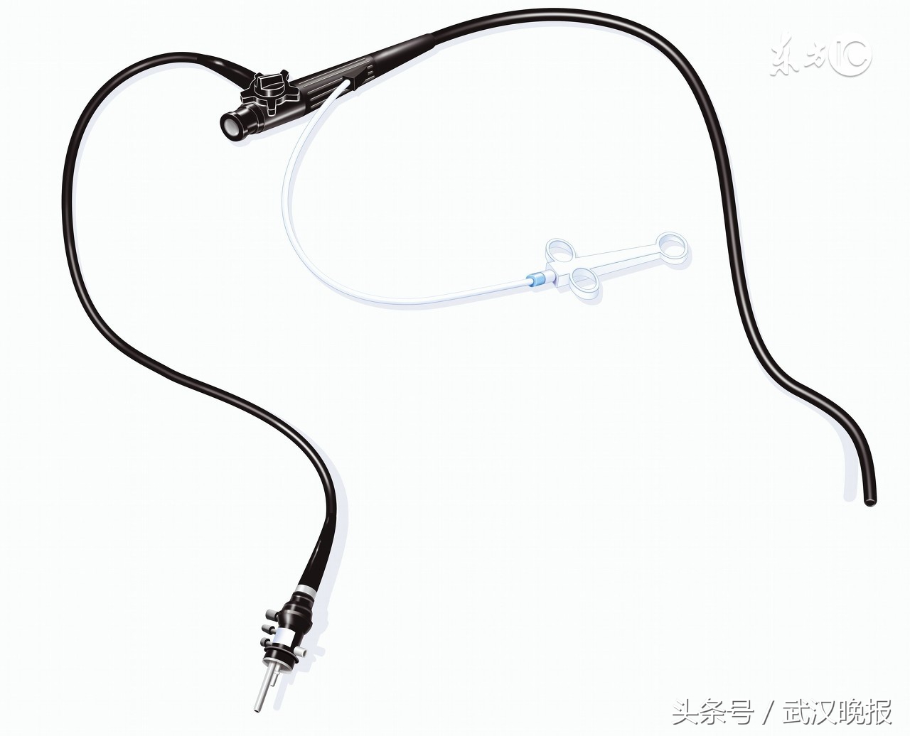 鱼刺卡喉五个月了快速取出鱼刺,鱼刺卡喉切莫强吞刺穿肠管太危险