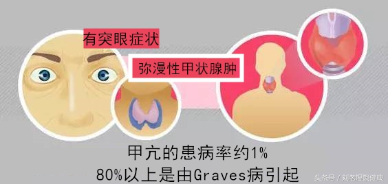 谈谈甲亢,gd型甲亢严重吗