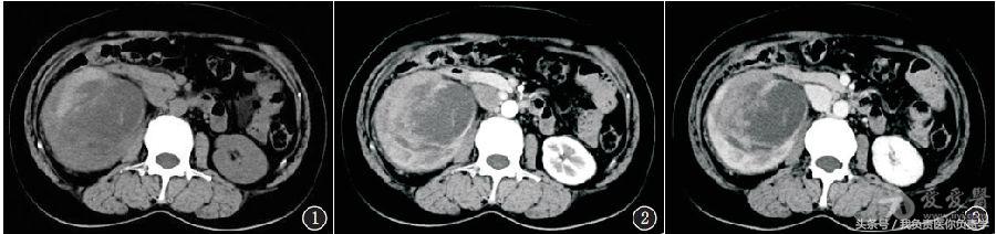 女子腰痛查出两种癌,女子看腰痛意外查出肺癌