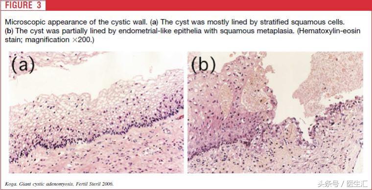 从肌瘤剔除术到全子宫切除术，一个年轻姑娘的无奈
