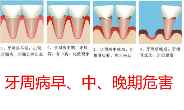 牙周病经久不愈要关注了，你可能是得了糖尿病！
