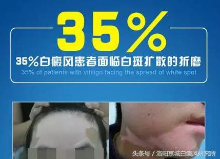 白癜风数据,白癜风正在处于发展高峰期怎么办