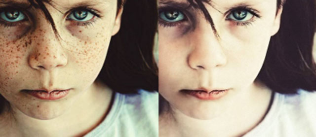 黄褐斑激光后反黑很严重怎么办,激光祛斑后反黑期间可以化妆吗