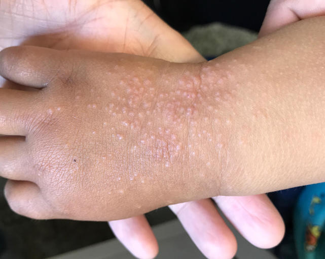 宝宝手背很多疹子,宝宝手背好多小包