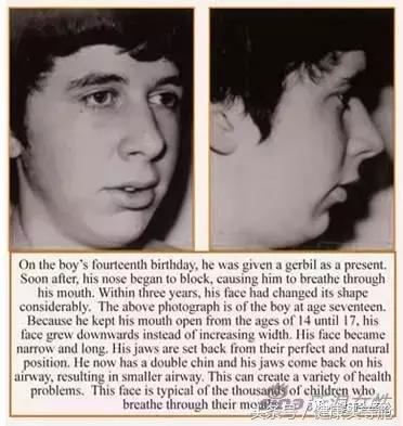 用嘴呼吸的对容貌的影响,用嘴呼吸会导致什么面容