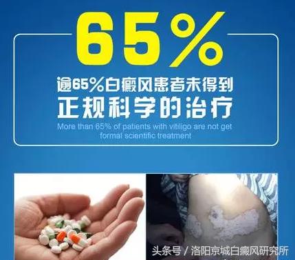 白癜风数据,白癜风正在处于发展高峰期怎么办