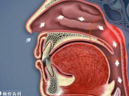 用嘴呼吸的对容貌的影响,用嘴呼吸会导致什么面容