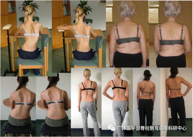 脊柱侧弯暑期训练营招募,脊柱侧弯夏令营视频