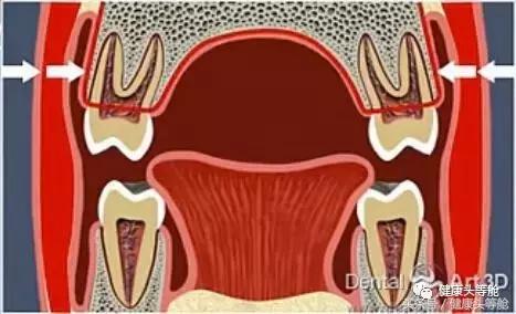 用嘴呼吸的对容貌的影响,用嘴呼吸会导致什么面容