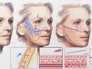 左右脸分别埋入15根线蛋白线女子“减龄”不成脸还肿成粽子状！