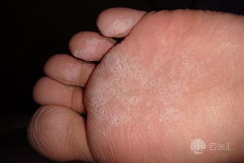 香港脚可以用碘伏吗,香港脚可以擦爽身粉吗