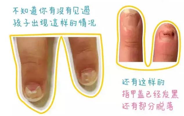 小孩手指甲断了可以重头长出来么,宝宝指甲断了要不要揭开断甲