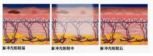 不神化的光子嫩肤，给皮肤反季节的吹弹可破！