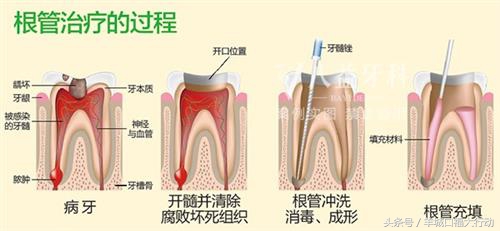 牙痛根管治疗就是杀神经吗,补牙牙痛必须要根管治疗吗