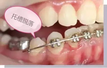 正畸戴牙环疼怎么办,正畸牙套戴不上了怎么办