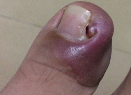 折磨我们的甲沟炎到底怎么回事？