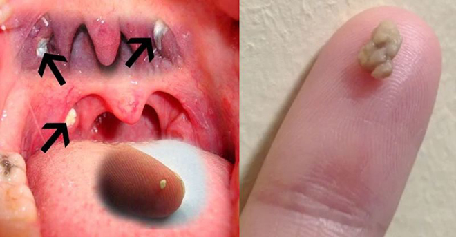 咳嗽咳出一粒白白的东西，以为是未吞下的米，拿起来一看吐了