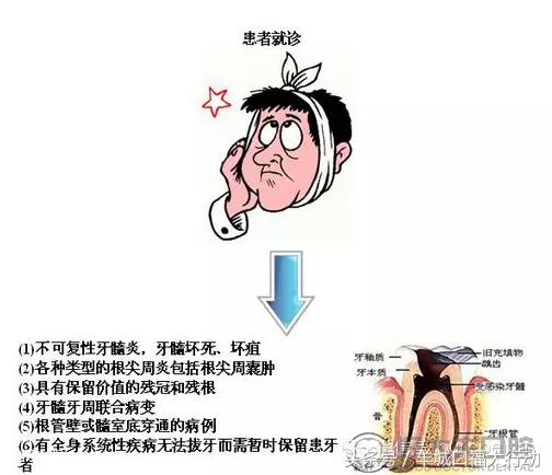 牙痛根管治疗就是杀神经吗,补牙牙痛必须要根管治疗吗