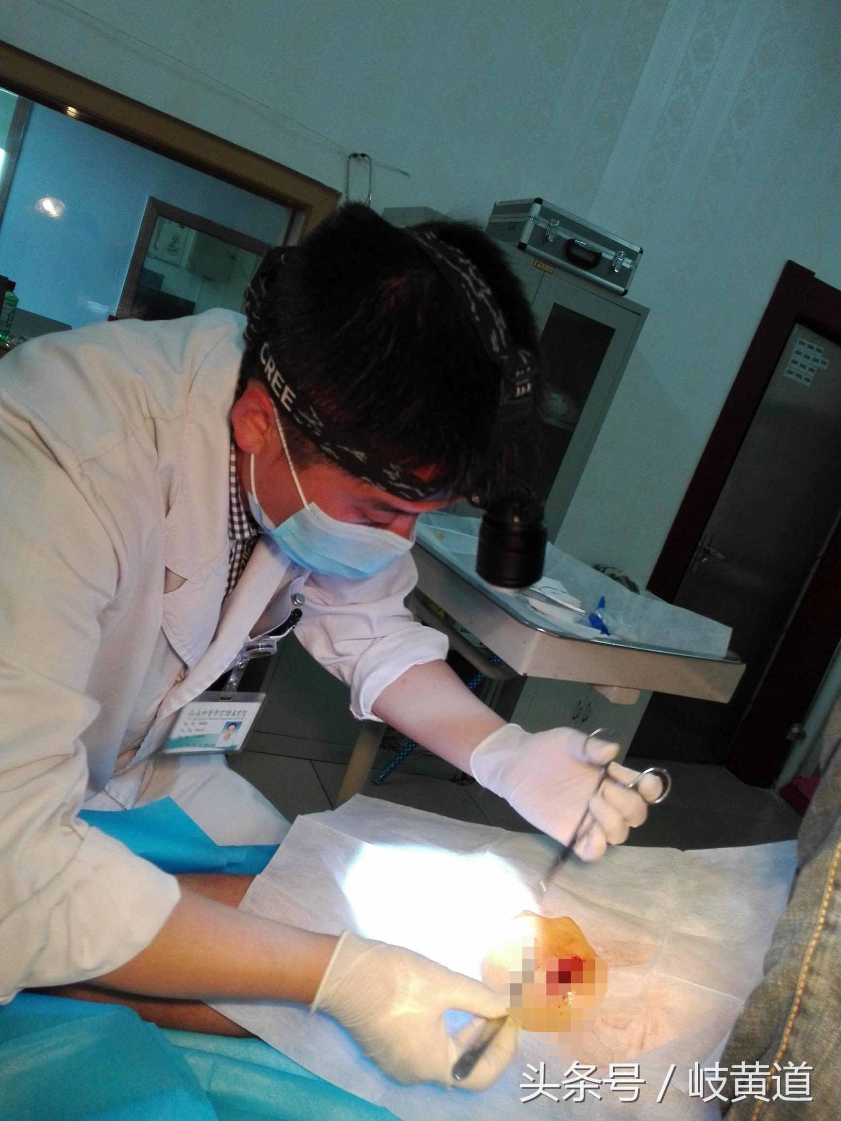 钢渣扎进男子大腿 医生手术2小时取出