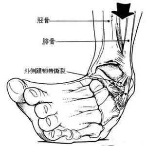 路滑伤脚,路滑摔倒了腿受伤怎么处理