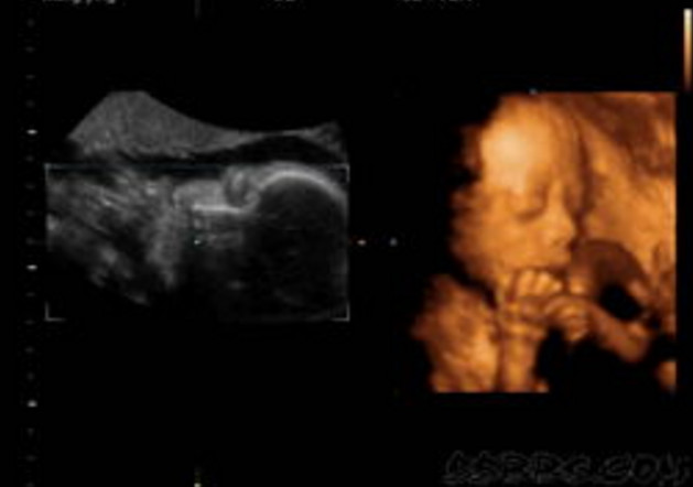 唇腭裂和兔唇四维提示什么,b超显示胎儿偏大一周会提前生吗