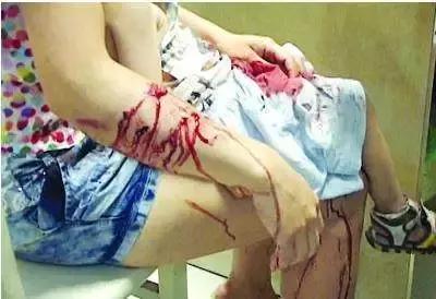 被猫狗咬伤没出血,被狗咬出血了一定要打狂犬疫苗吗