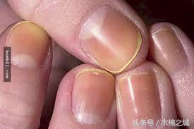 宝宝指甲颜色看起来不均匀,宝宝指甲发黄是什么预兆