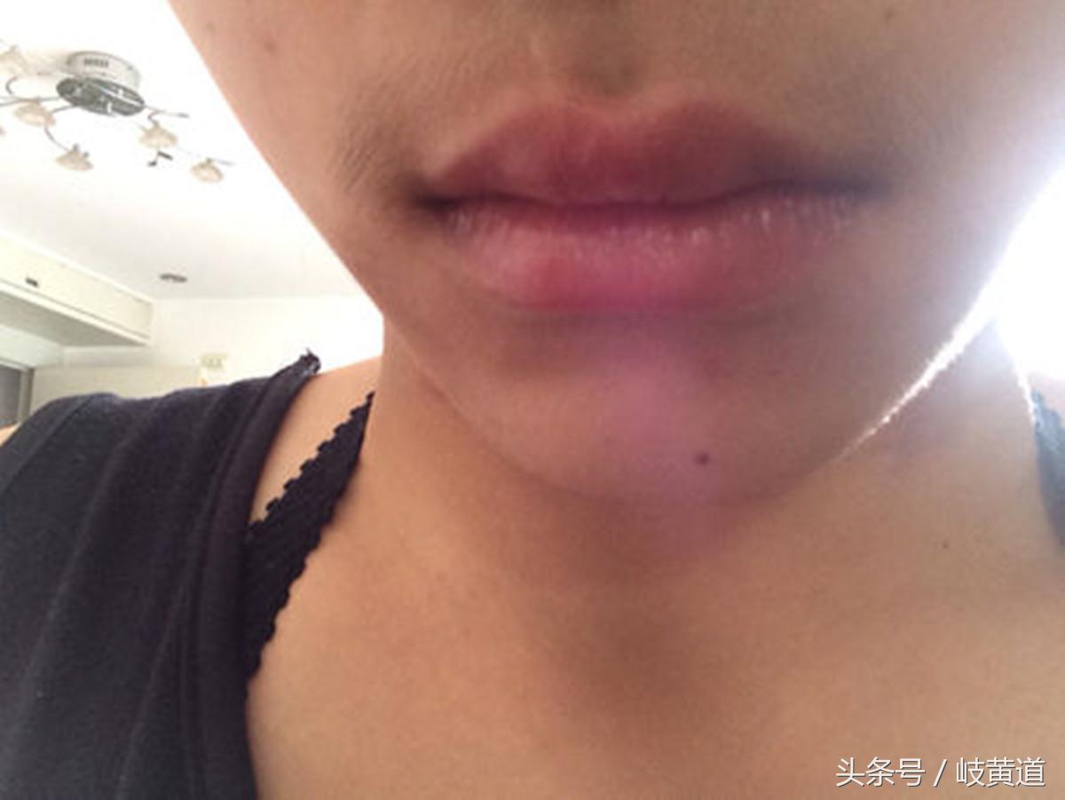 女生长胡子长痘痘是怎么回事,女生长胡子脸上长痘