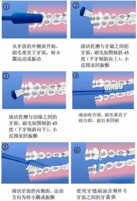 正畸戴牙环疼怎么办,正畸牙套戴不上了怎么办