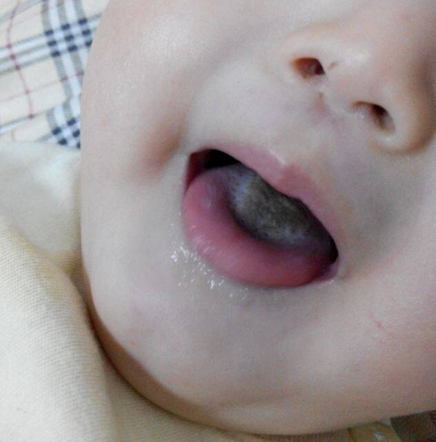 宝宝吃母乳舌苔黄是怎么回事,母乳宝宝舌苔白厚需要清理吗