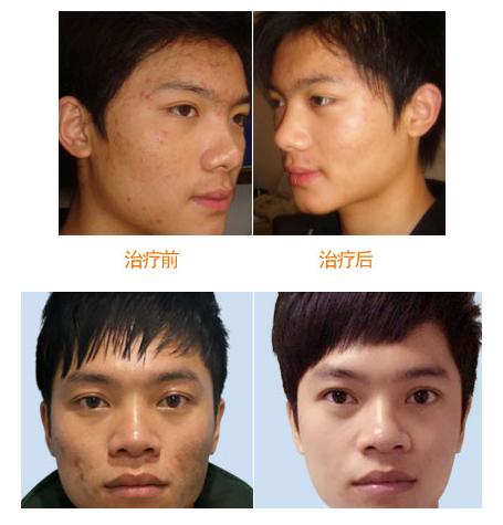 不神化的光子嫩肤，给皮肤反季节的吹弹可破！