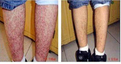 胡桂生谈紫癜病的最佳治疗方案,孩子得了过敏性紫癜家长很紧张