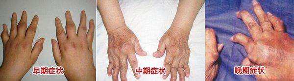 风湿性关节炎喝酒的严重后果,关节炎和风湿性关节炎的区别