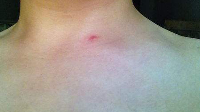 身上长红痣是肝出问题了吗,身上长红痣该查肝炎吗