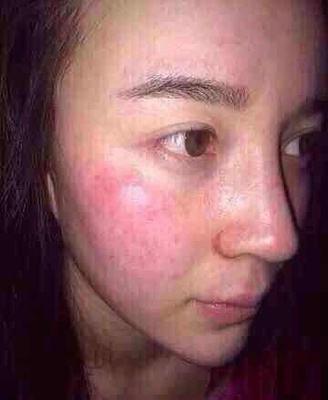 一着急脸红发烫什么原因,一热就脸红发烫头晕是怎么回事