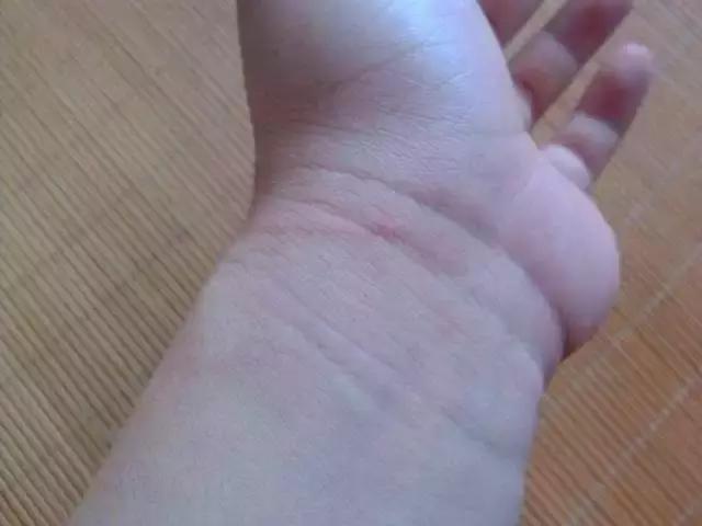 被猫狗咬伤没出血,被狗咬出血了一定要打狂犬疫苗吗