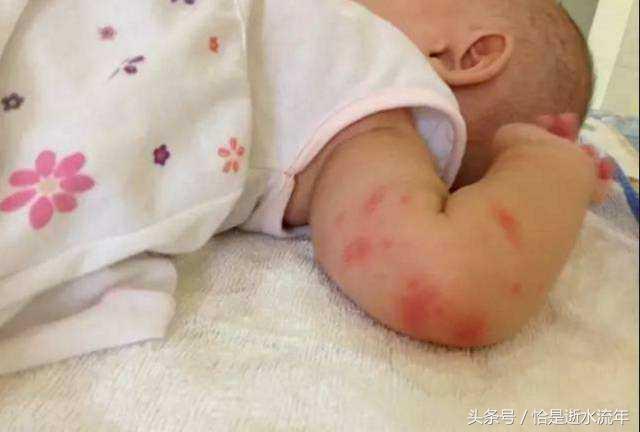 被蚊虫叮咬红肿有小红块怎么解决,宝宝蚊虫叮咬后红肿严重怎么办