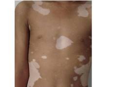 白癜风的人睡过的被子传染不,请问专家白癜风会传染吗