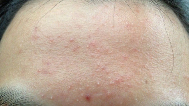 身上长红痣是肝出问题了吗,身上长红痣该查肝炎吗