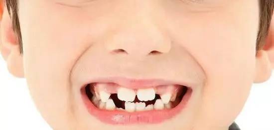 替牙期牙齿需要矫正吗,替牙期牙齿