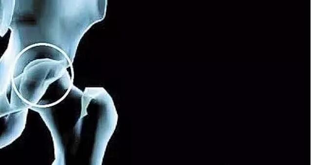 小儿股骨头坏死治疗周期,股骨头坏死置换假体寿命多久