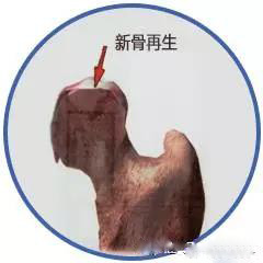 45岁股骨头坏死2期换什么样假体好,如何治疗股骨头坏死有效