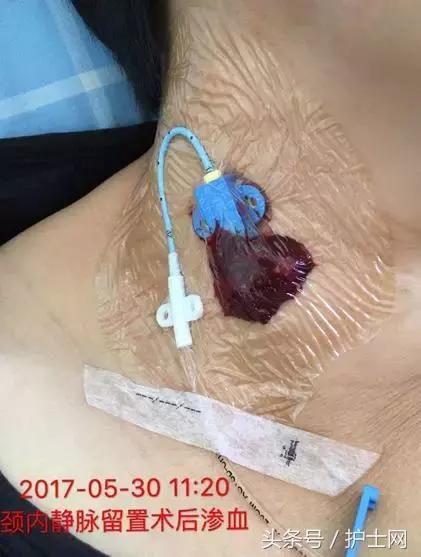 更换敷贴的操作视频,怎么换敷贴