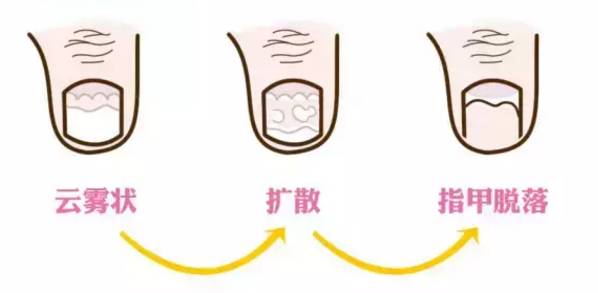 小孩手指甲断了可以重头长出来么,宝宝指甲断了要不要揭开断甲
