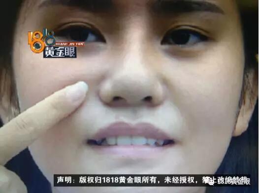 做鼻子整形手术后遗症,做鼻子手术女孩