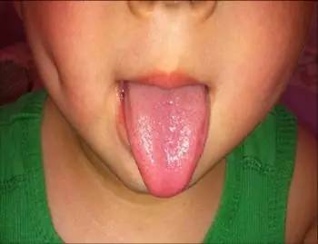 小儿舌苔白腻,小儿斑驳舌苔